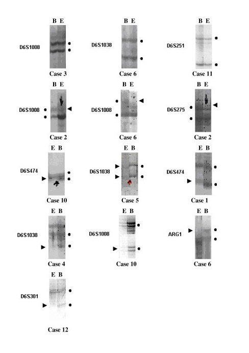 gene alterations in patients with mesothelioma